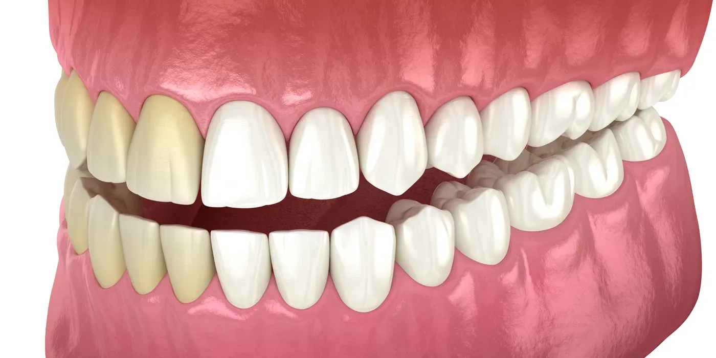 A comparison of stained teeth beside brightened teeth after professional whitening