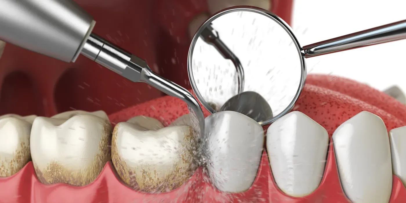 A hygienist’s scaler and mirror removing buildup from teeth during a professional cleaning
