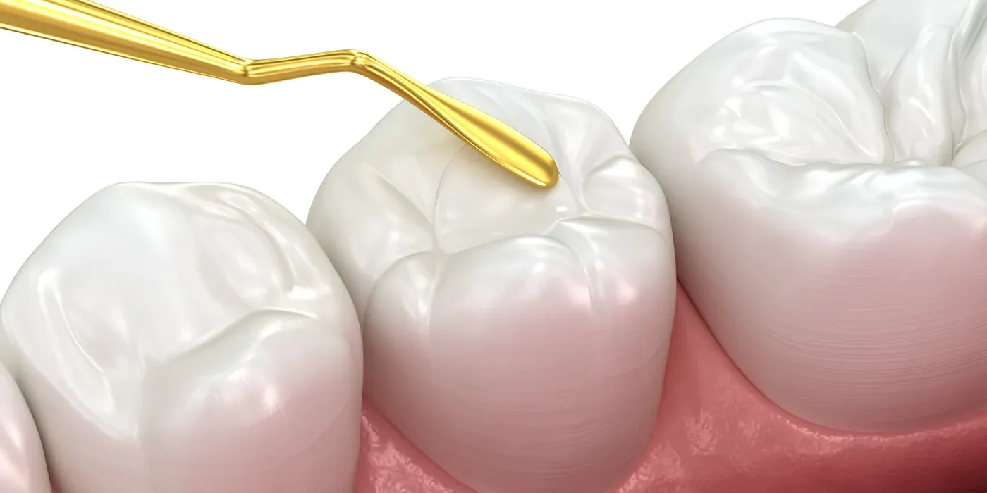 A dental instrument placing a tooth-colored filling into a molar