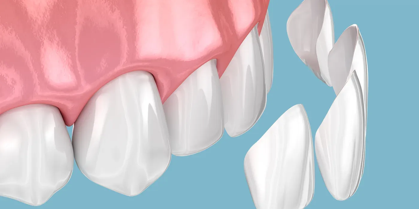 Thin porcelain veneer shells shown beside the front teeth they will cover