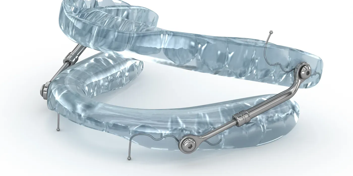 A clear custom oral appliance used to hold the jaw forward and keep the airway open during sleep