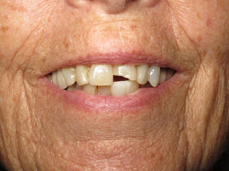 Dentures Dentist Grandville MI