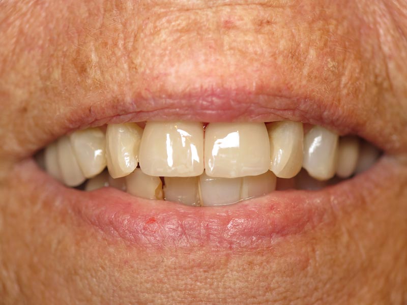 Dentures Dentist Grandville MI