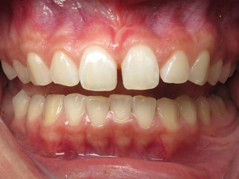 Teeth Whitening Grandville Dentist 1