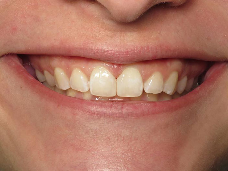 Teeth Whitening Grandville Dentist 2