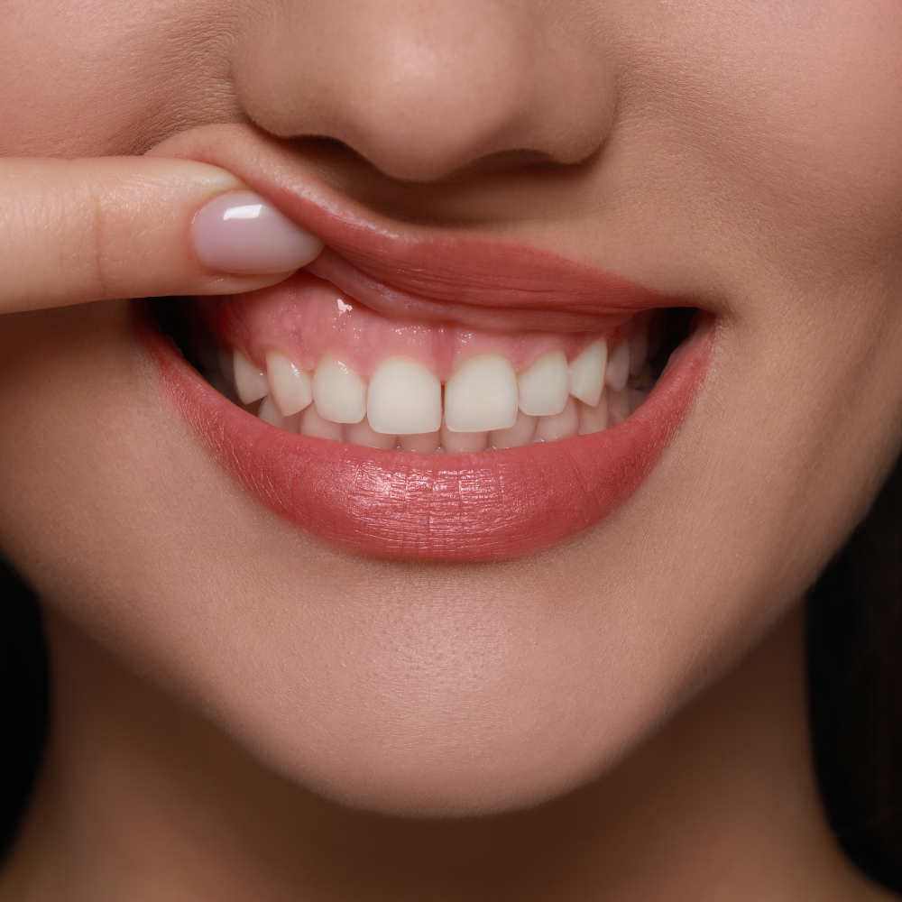 Woman showing her gums