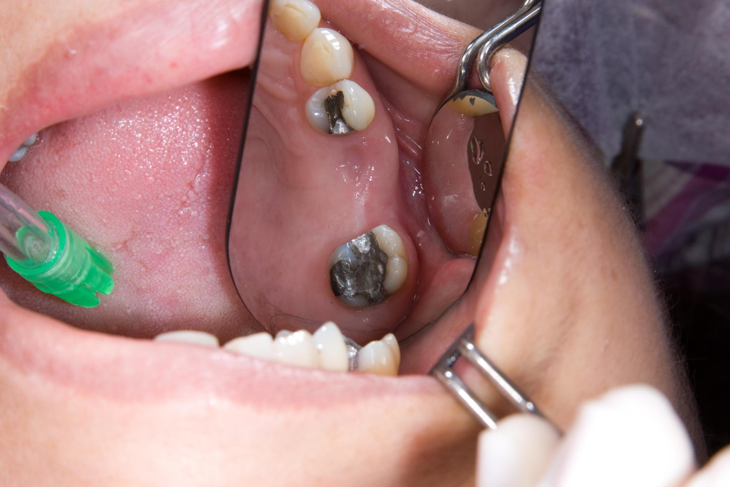 Dental Fillings